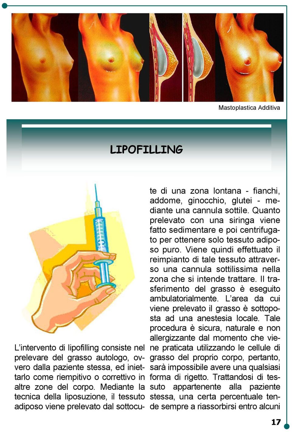 Quanto prelevato con una siringa viene fatto sedimentare e poi centrifugato per ottenere solo tessuto adiposo puro.