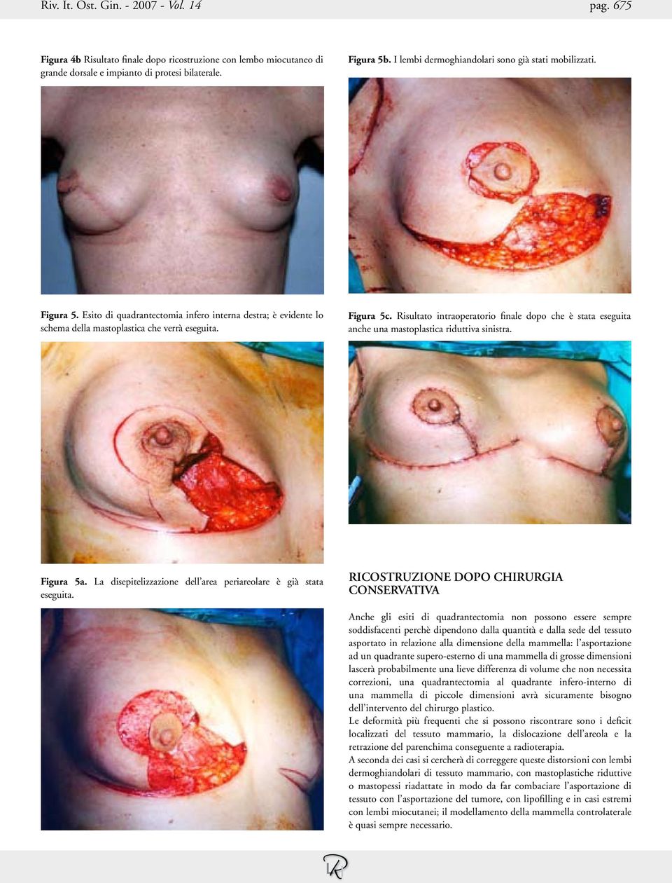 Risultato intraoperatorio finale dopo che è stata eseguita anche una mastoplastica riduttiva sinistra. Figura 5a. La disepitelizzazione dell area periareolare è già stata eseguita.