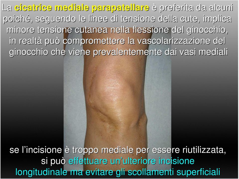 vascolarizzazione del ginocchio che viene prevalentemente dai vasi mediali se l incisione l è troppo mediale