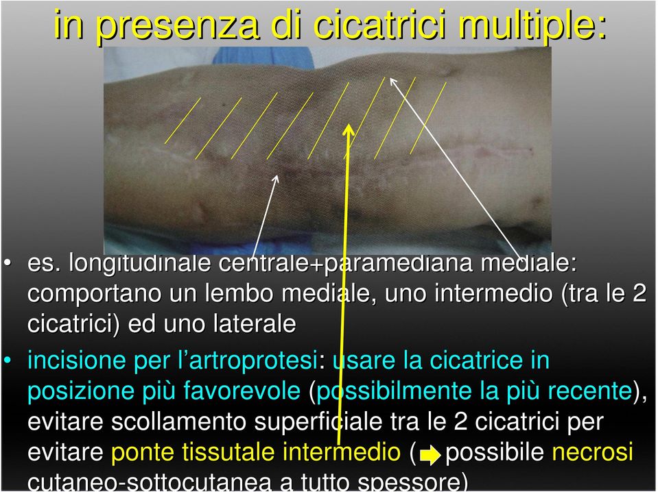 ed uno laterale incisione per l artroprotesil artroprotesi: usare la cicatrice in posizione più favorevole