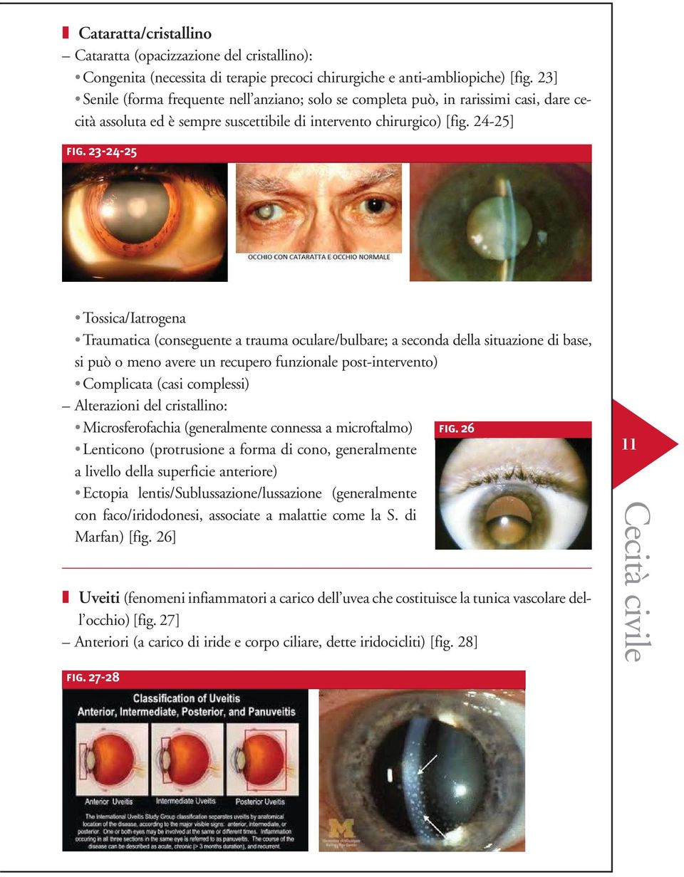 23-24-25 Tossica/Iatrogena Traumatica (conseguente a trauma oculare/bulbare; a seconda della situazione di base, si può o meno avere un recupero funzionale post-intervento) Complicata (casi