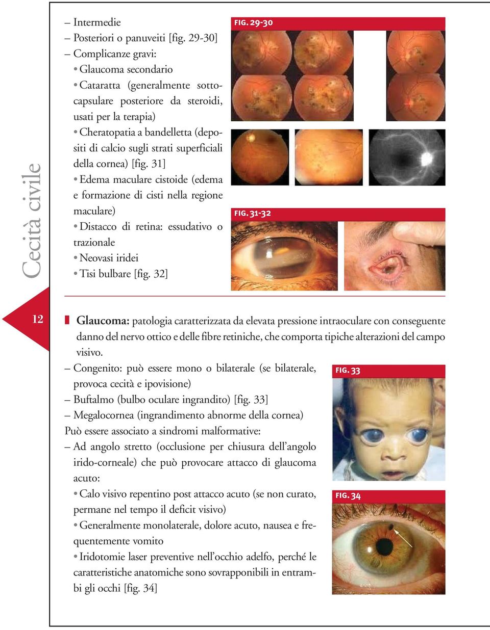 superficiali della cornea) [fig. 31] Edema maculare cistoide (edema e formazione di cisti nella regione maculare) Distacco di retina: essudativo o trazionale Neovasi iridei Tisi bulbare [fig. 32] fig.