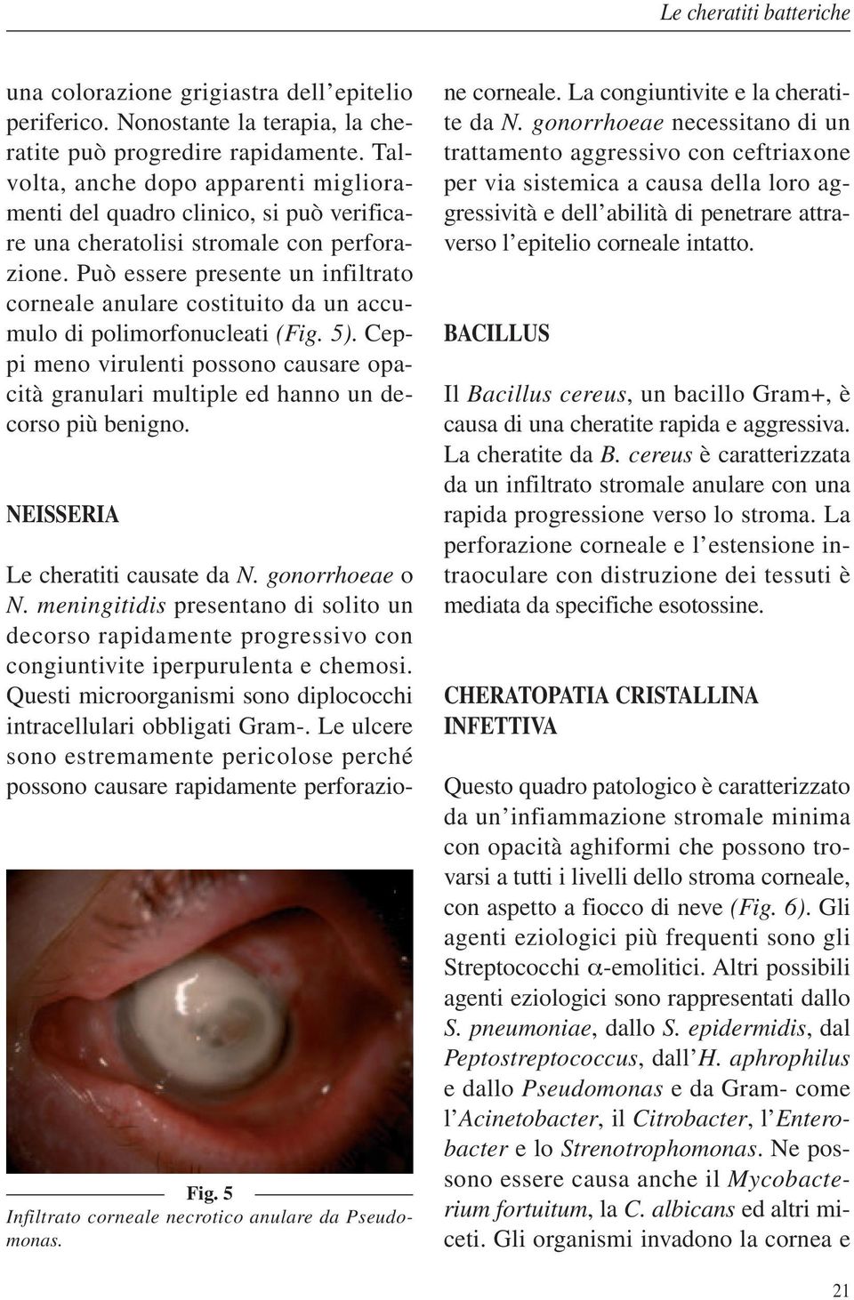 Può essere presente un infiltrato corneale anulare costituito da un accumulo di polimorfonucleati (Fig. 5).