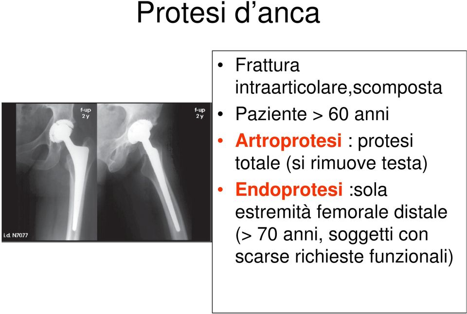 rimuove testa) Endoprotesi :sola estremità femorale