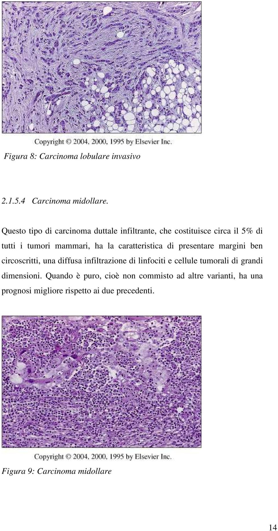 caratteristica di presentare margini ben circoscritti, una diffusa infiltrazione di linfociti e cellule