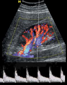 Eco Color Doppler Arterie Renali Indice di Resistenza (Ampiezza