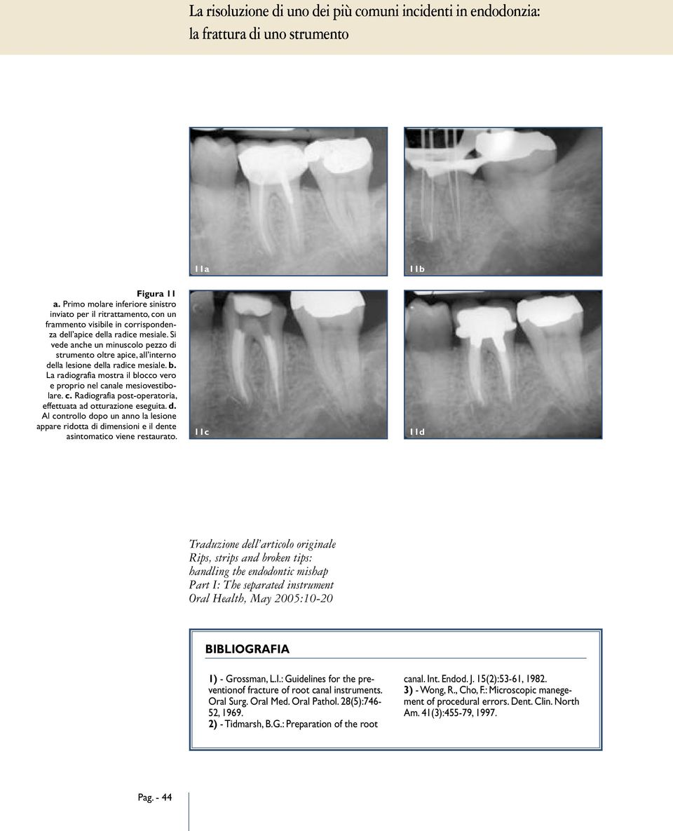 Si vede anche un minuscolo pezzo di strumento oltre apice, all interno della lesione della radice mesiale. b. La radiografia mostra il blocco vero e proprio nel ca