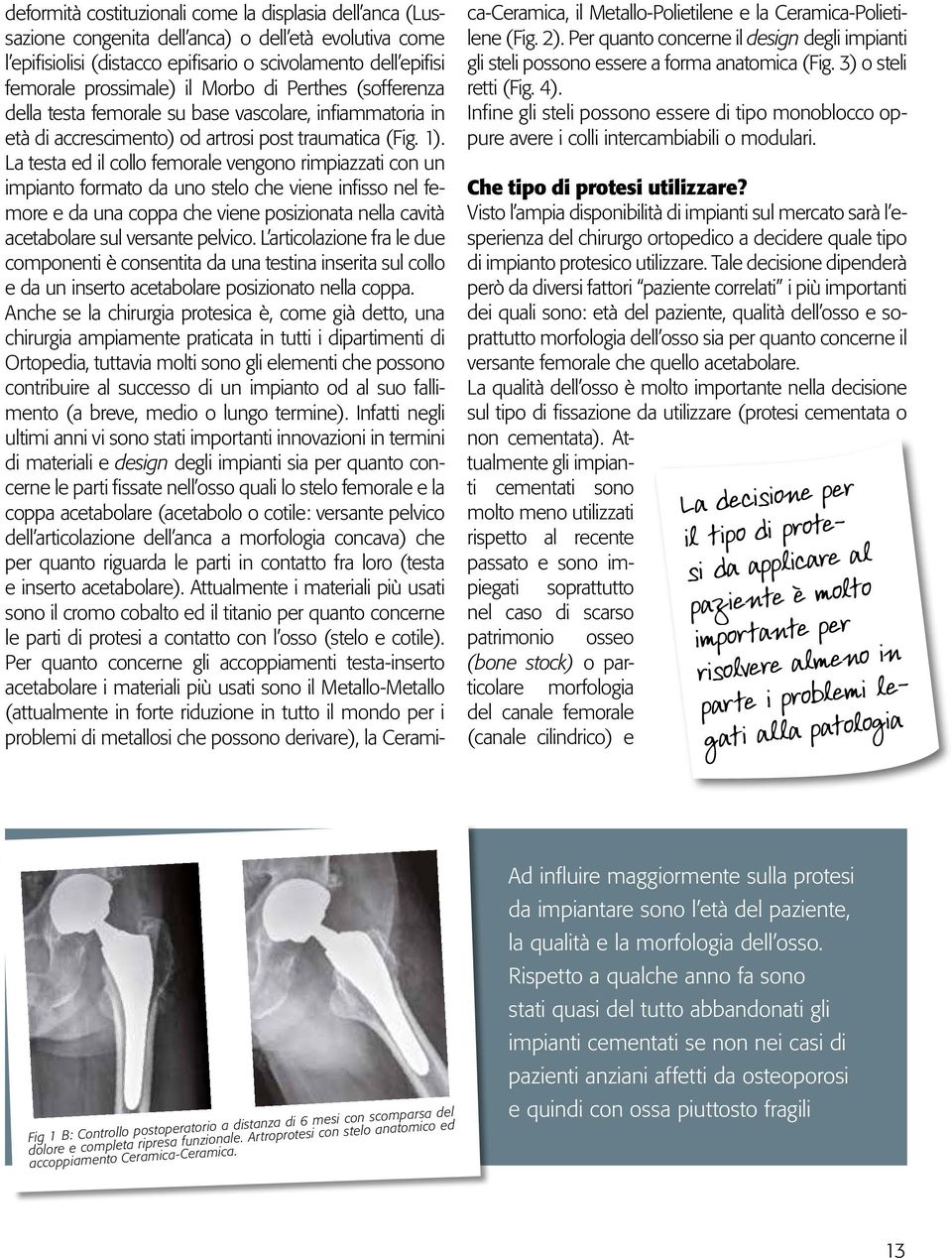 La testa ed il collo femorale vengono rimpiazzati con un impianto formato da uno stelo che viene infisso nel femore e da una coppa che viene posizionata nella cavità acetabolare sul versante pelvico.