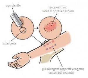 I Prick Test Hanno un alto grado di correlazione con i sintomi e hanno un alta