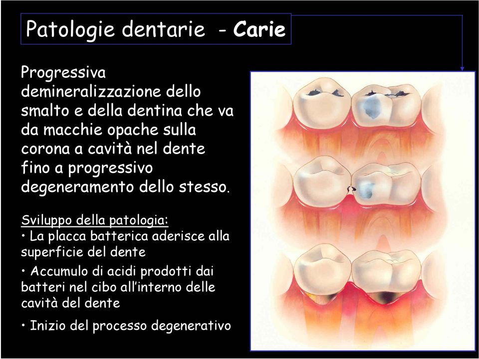 Sviluppo della patologia: La placca batterica aderisce alla superficie del dente Accumulo di