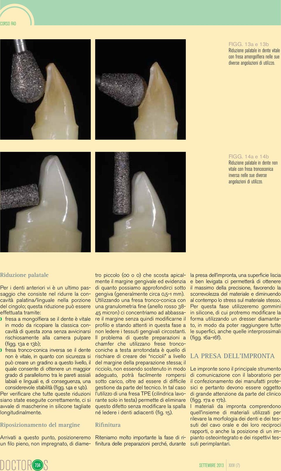fresa a mongolfiera se il dente è vitale in modo da ricopiare la classica concavità di questa zona senza avvicinarsi rischiosamente alla camera pulpare (figg.