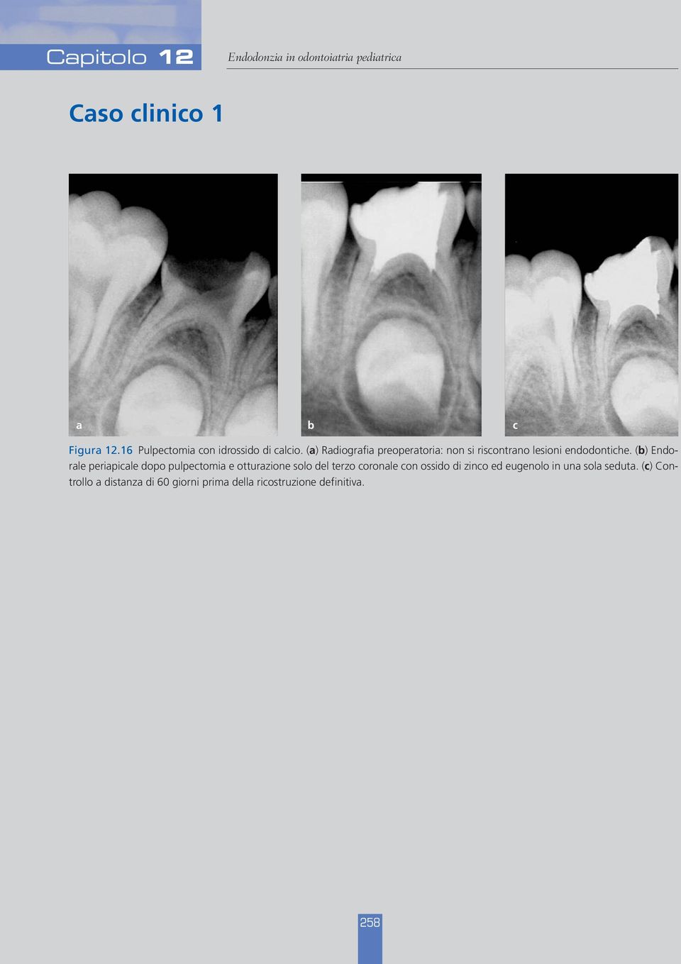 (b) Endorale periapicale dopo pulpectomia e otturazione solo del terzo coronale con