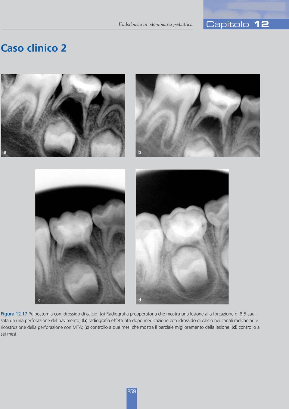 5 causata da una perforazione del pavimento; (b) radiografia effettuata dopo medicazione con idrossido di