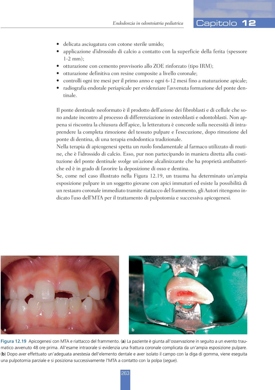 periapicale per evidenziare l avvenuta formazione del ponte dentinale.