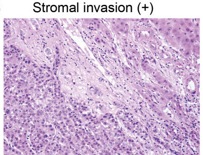 guided core biopsy tumor cell invasion into the intratumoral portal