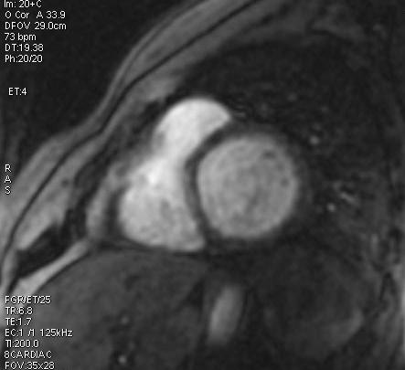 PERFUSIONE FGRE-T1 Acquisizione di 3 strati in un singolo battito cardiaco 3 immag in AC sottomitralico papillare parapuntale Mdc vel