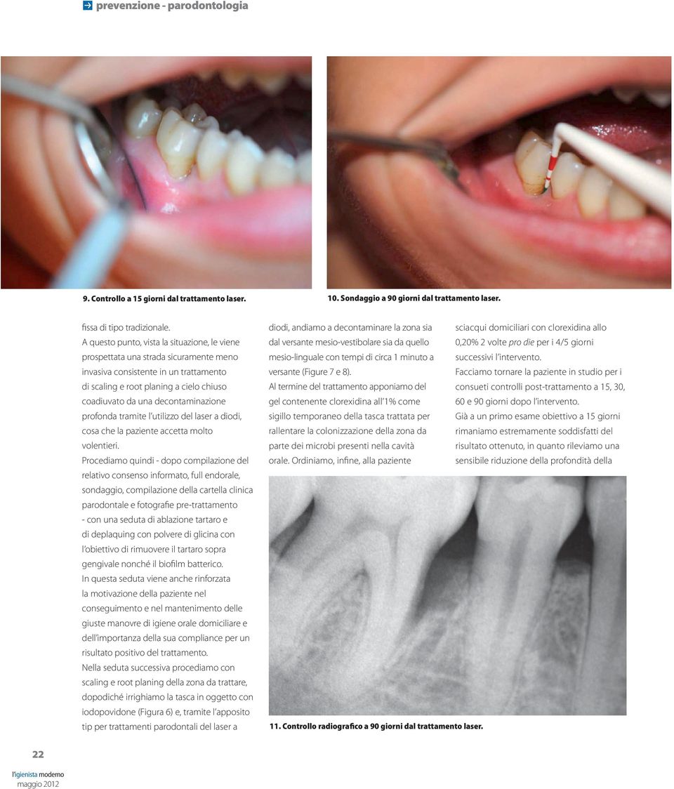 decontaminazione profonda tramite l utilizzo del laser a diodi, cosa che la paziente accetta molto volentieri.