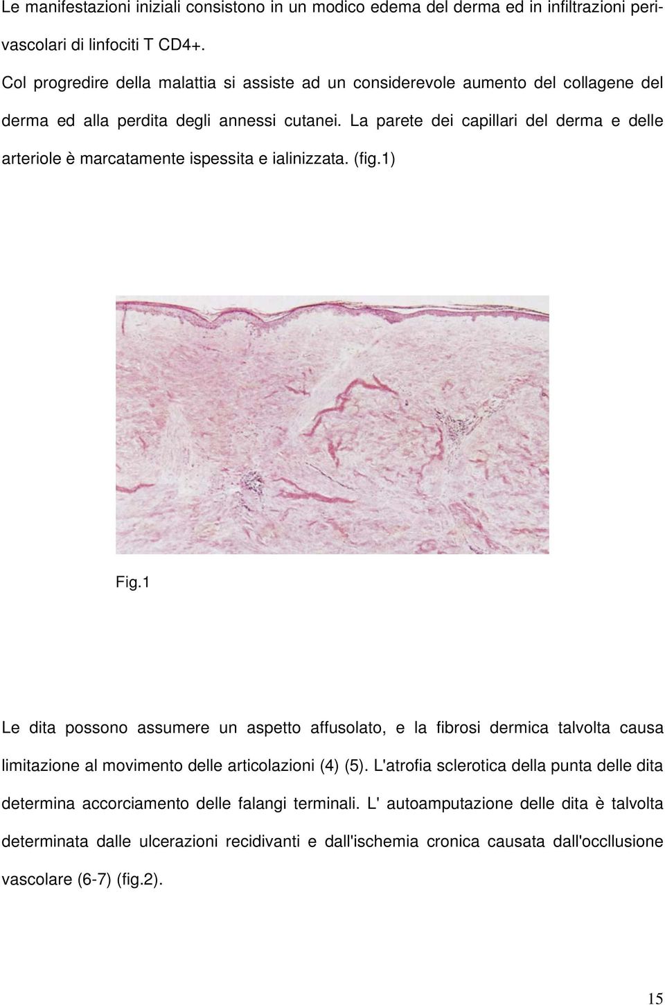 La parete dei capillari del derma e delle arteriole è marcatamente ispessita e ialinizzata. (fig.1) Fig.