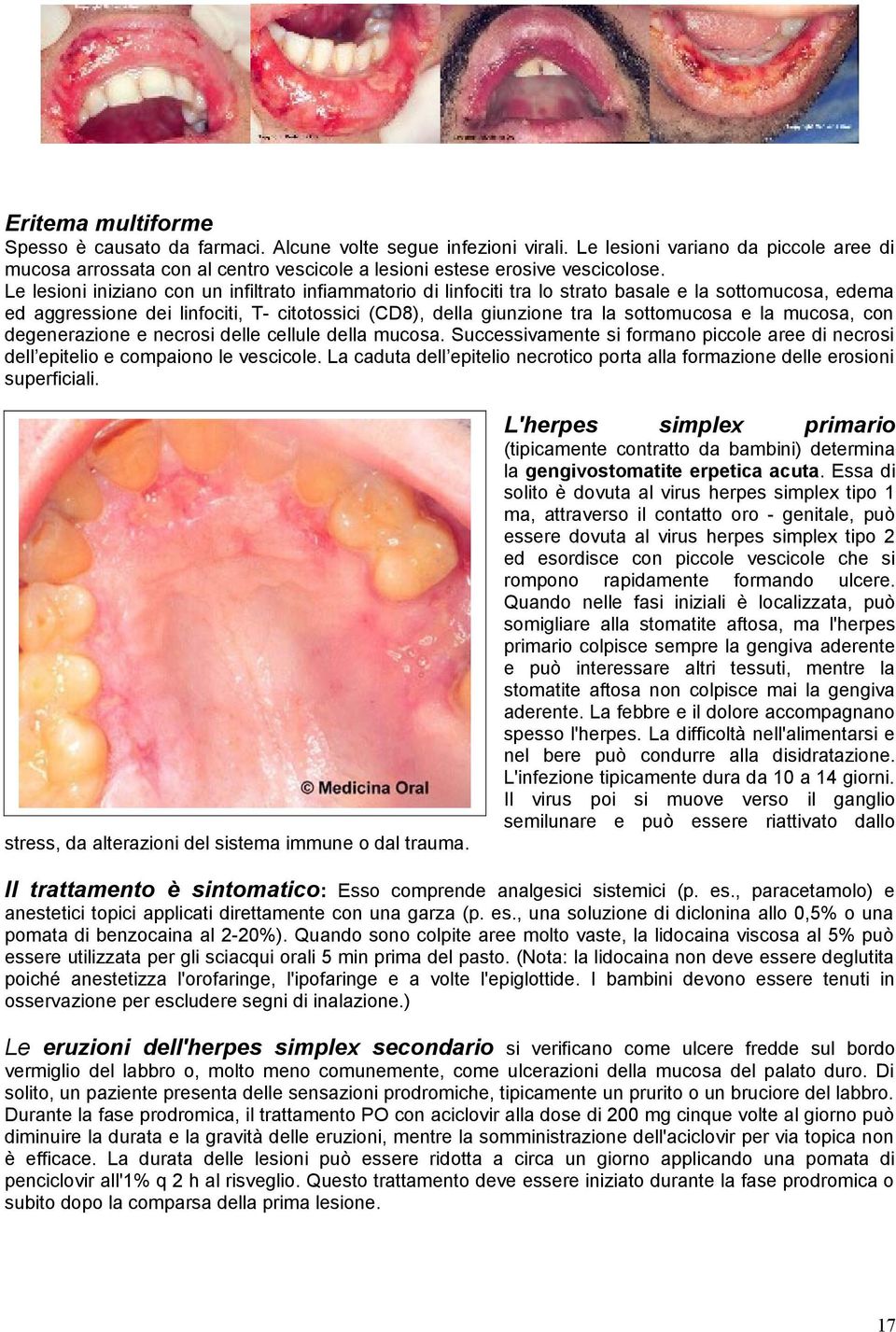 Le lesioni iniziano con un infiltrato infiammatorio di linfociti tra lo strato basale e la sottomucosa, edema ed aggressione dei linfociti, T- citotossici (CD8), della giunzione tra la sottomucosa e