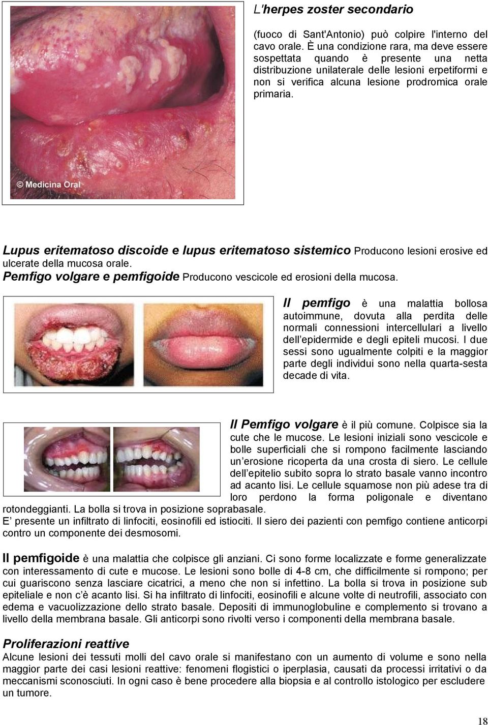 Lupus eritematoso discoide e lupus eritematoso sistemico Producono lesioni erosive ed ulcerate della mucosa orale. Pemfigo volgare e pemfigoide Producono vescicole ed erosioni della mucosa.