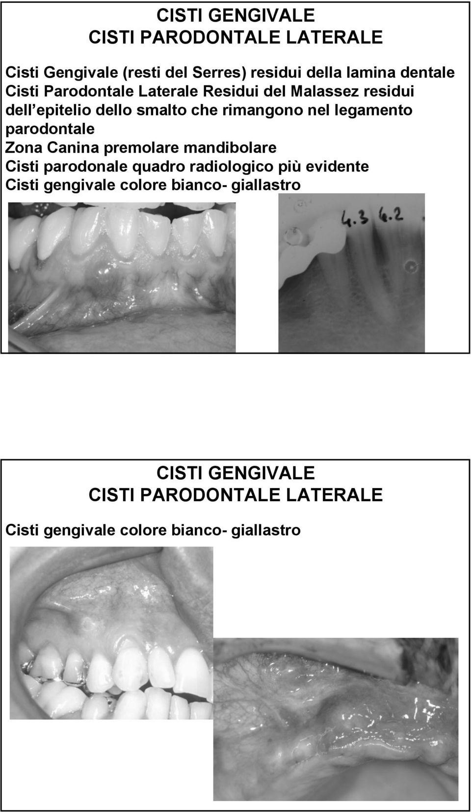 parodontale Zona Canina premolare mandibolare Cisti parodonale quadro radiologico più evidente Cisti gengivale