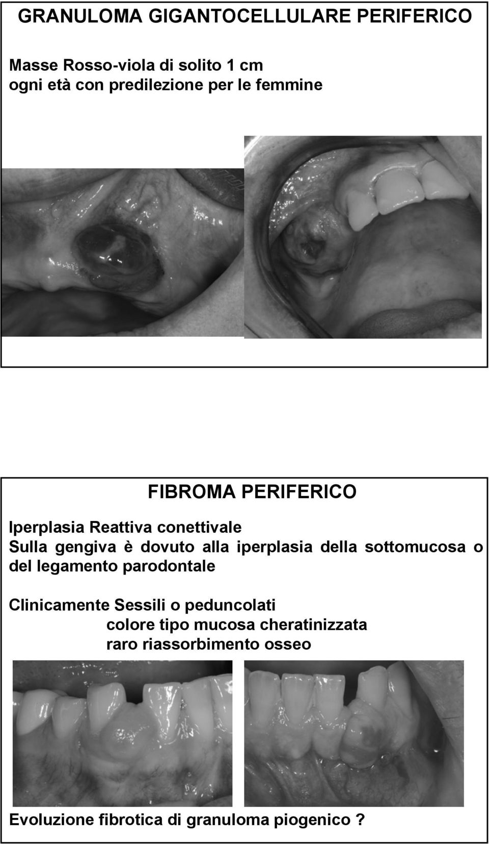 iperplasia della sottomucosa o del legamento parodontale Clinicamente Sessili o peduncolati