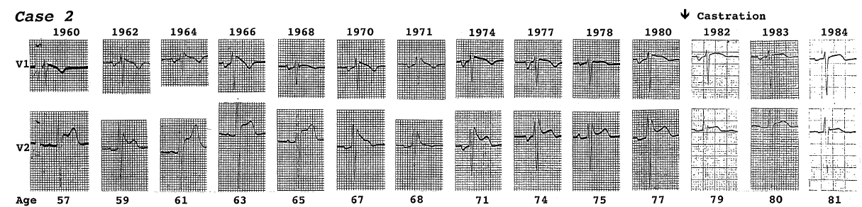 Matsuo et al _ Pacing Clin