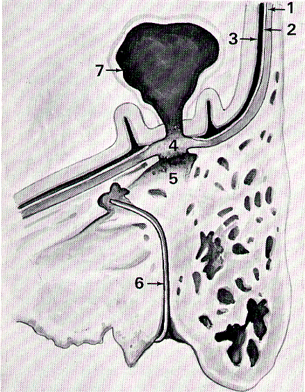 Nervo facciale Ascesso intracerebrale Tegmen