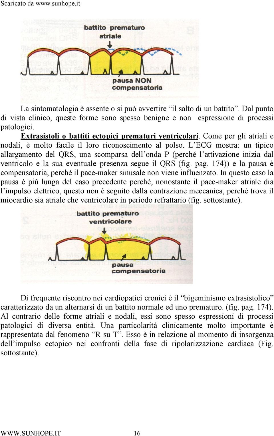 L ECG mostra: un tipico allargamento del QRS, una scomparsa dell onda P (perché l attivazione inizia dal ventricolo e la sua eventuale presenza segue il QRS (fig. pag.