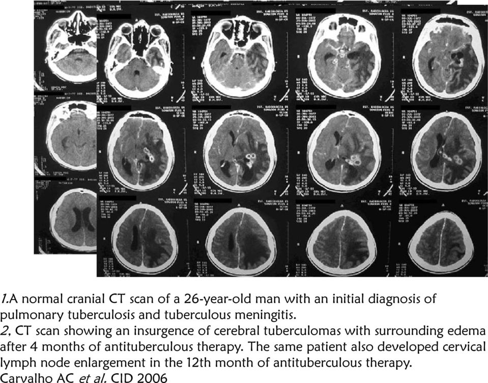 2, CT scan showing an insurgence of cerebral tuberculomas with surrounding edema after 4 months