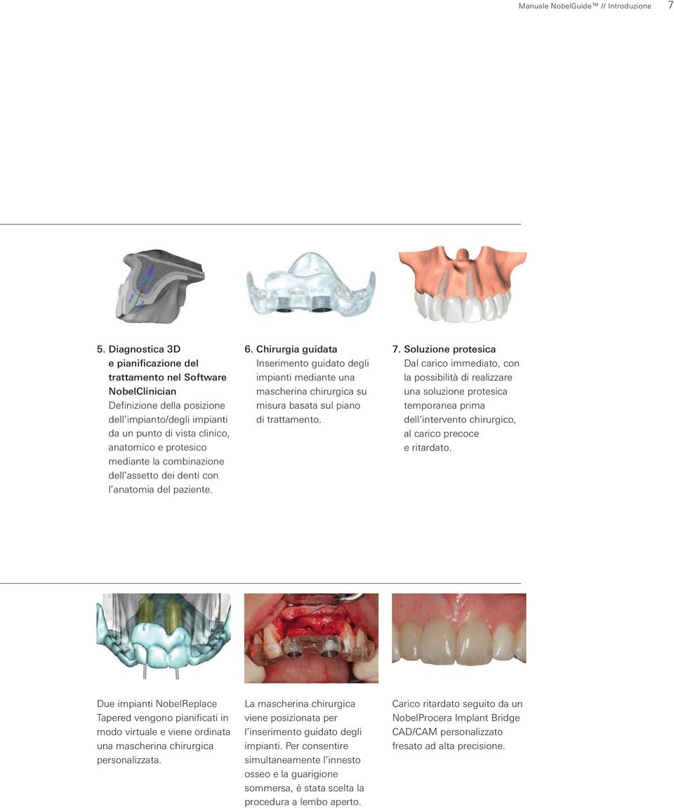 combinazione dell assetto dei denti con l anatomia del paziente. 6. Chirurgia guidata Inserimento guidato degli impianti mediante una mascherina chirurgica su misura basata sul piano di trattamento.