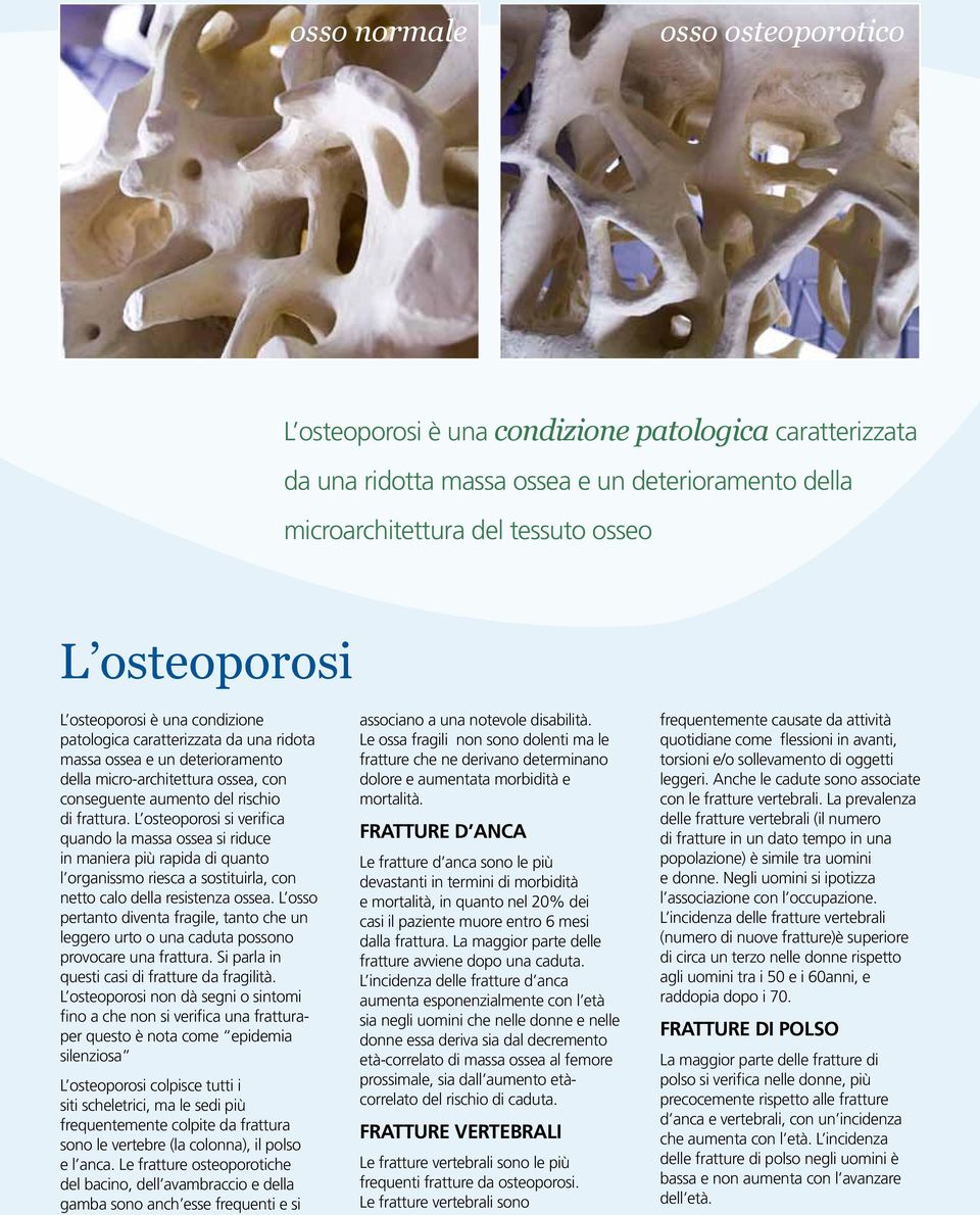 L osteoporosi si verifica quando la massa ossea si riduce in maniera più rapida di quanto l organissmo riesca a sostituirla, con netto calo della resistenza ossea.