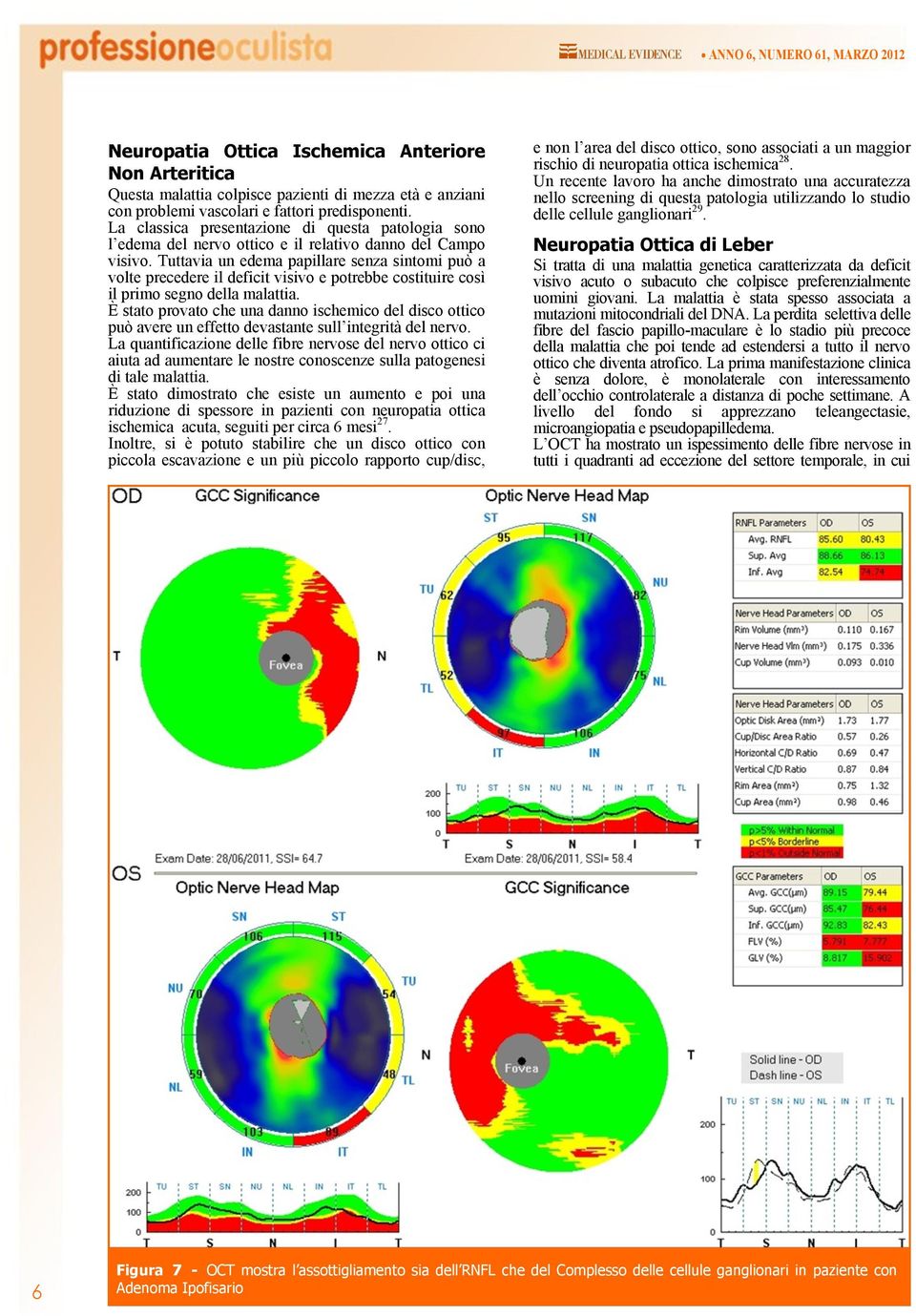 Tuttavia un edema papillare senza sintomi può a volte precedere il deficit visivo e potrebbe costituire così il primo segno della malattia.