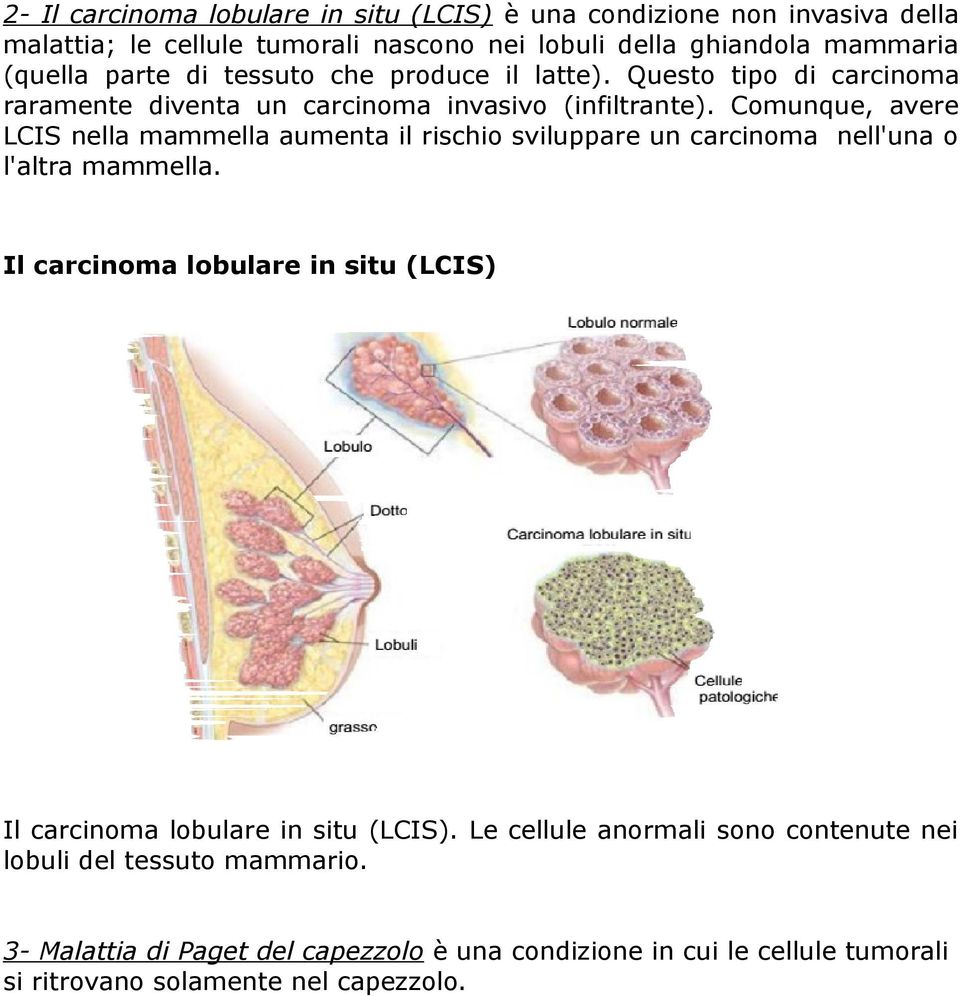 Comunque, avere LCIS nella mammella aumenta il rischio sviluppare un carcinoma nell'una o l'altra mammella.