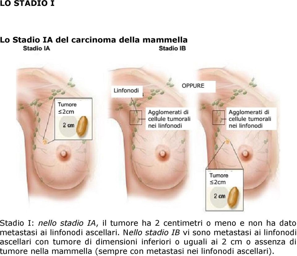 Nello stadio IB vi sono metastasi ai linfonodi ascellari con tumore di dimensioni