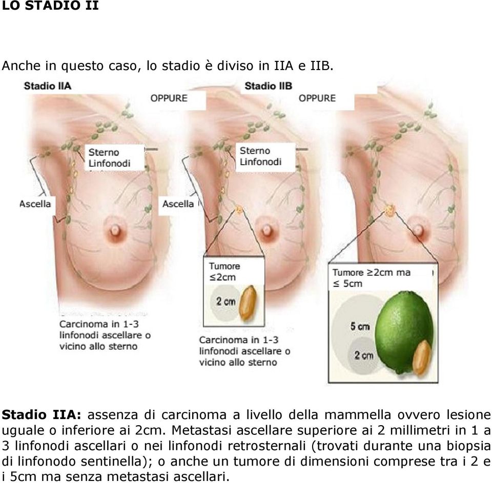 Metastasi ascellare superiore ai 2 millimetri in 1 a 3 linfonodi ascellari o nei linfonodi