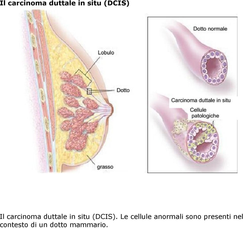 nel contesto di un dotto mammario.