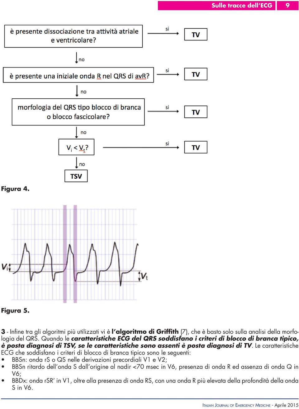 Le caratteristiche ECG che soddisfano i criteri di blocco di branca tipico sono le seguenti: BBSn: onda rs o QS nelle derivazioni precordiali V1 e V2; BBSn ritardo dell onda S dall