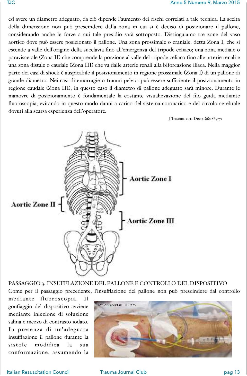 Distinguiamo tre zone del vaso aortico dove può essere posizionato il pallone.