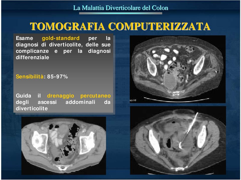 la diagnosi diagnosi differenziale differenziale Sensibilità: Sensibilità: 85-97% 85-97% Guida Guida il il