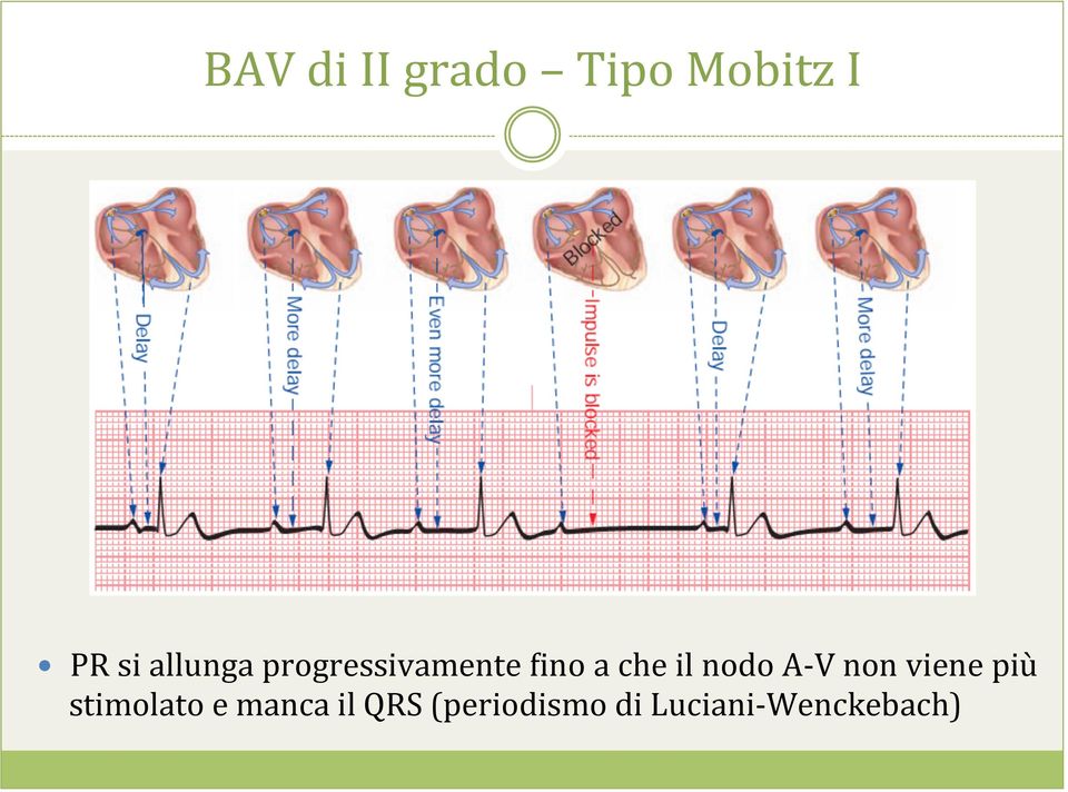 nodo A- V non viene più stimolato e