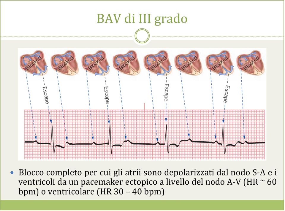 ventricoli da un pacemaker ectopico a livello