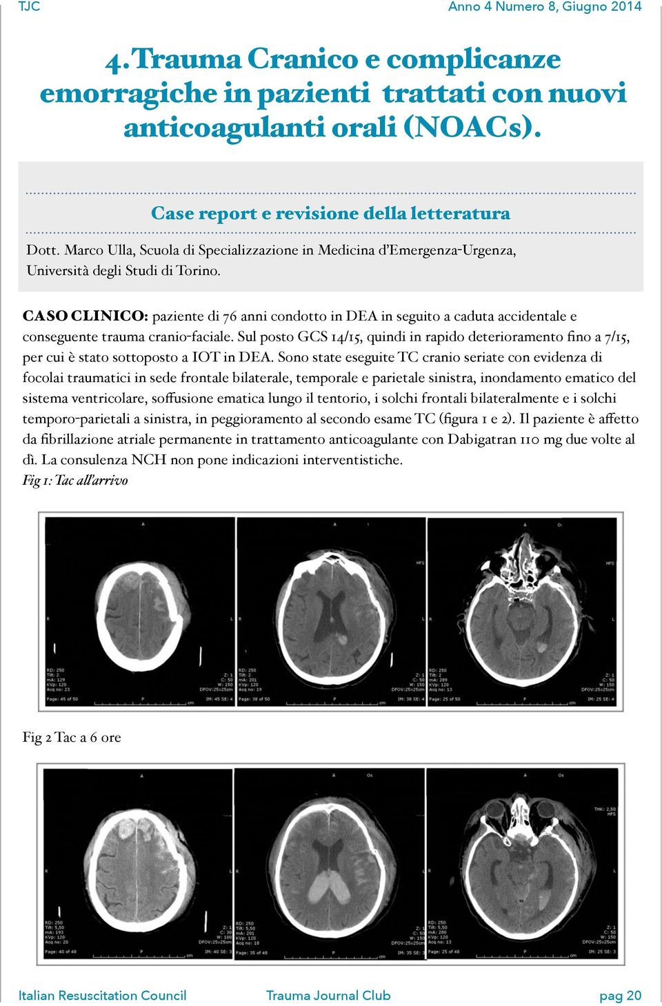 ' CASO CLINICO: paziente di 76 anni condotto in DEA in seguito a caduta accidentale e conseguente trauma cranio-faciale.