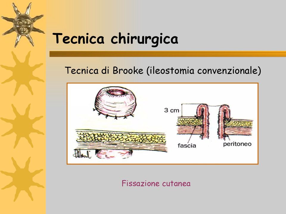 (ileostomia