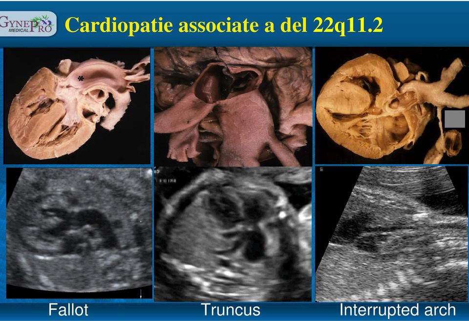 22q11.