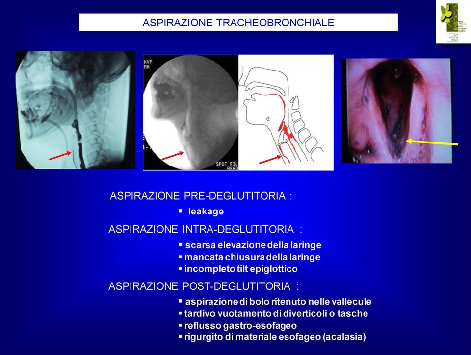 tilt epiglottico ASPIRAZIONE POST-DEGLUTITORIA : aspirazione di bolo ritenuto nelle vallecule