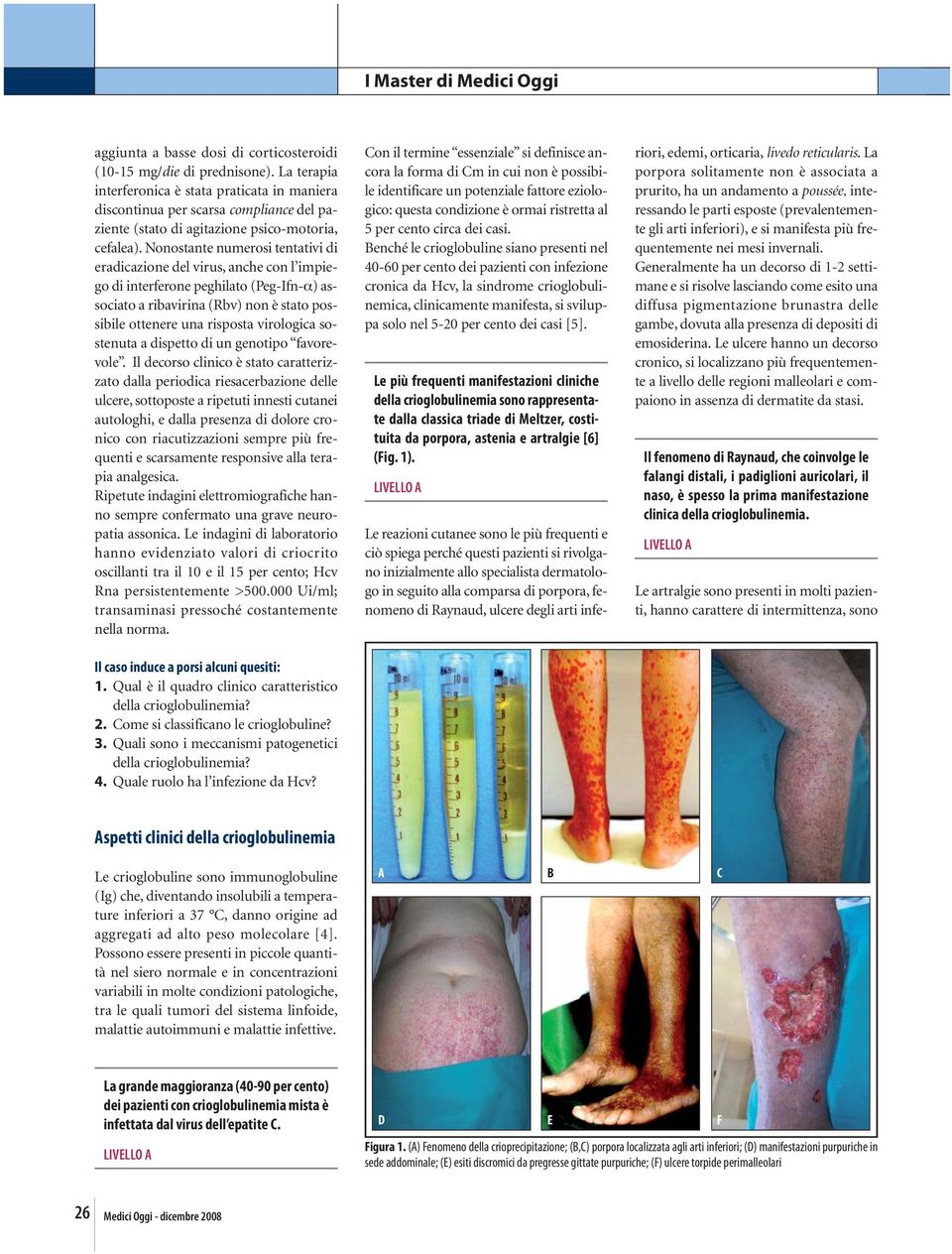 Nonostante numerosi tentativi di eradicazione del virus, anche con l impiego di interferone peghilato (Peg-Ifn-α) associato a ribavirina (Rbv) non è stato possibile ottenere una risposta virologica