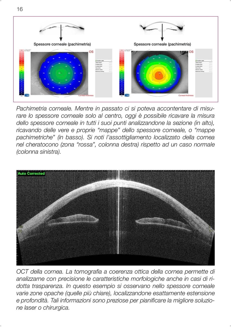 (in alto), ricavando delle vere e proprie mappe dello spessore corneale, o mappe pachimetriche (in basso).