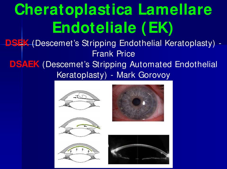 Keratoplasty) - Frank Price DSAEK (Descemet s