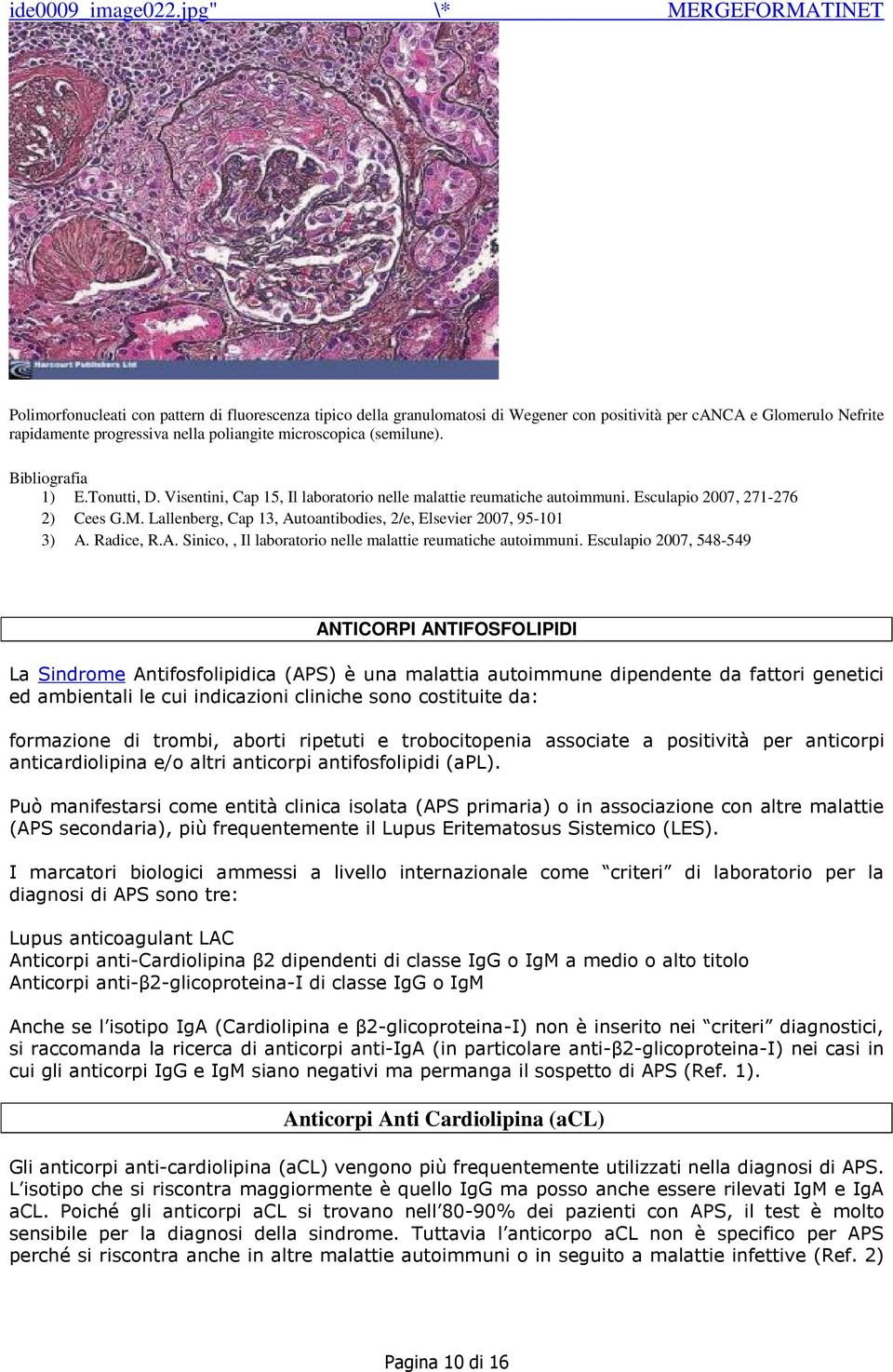 microscopica (semilune). Bibliografia 1) E.Tonutti, D. Visentini, Cap 15, Il laboratorio nelle malattie reumatiche autoimmuni. Esculapio 2007, 271-276 2) Cees G.M.